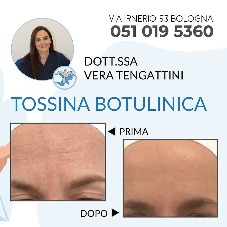 Dottoressa Vera Tengattini Trattamento Tossina Botulinica a Bologna presso Poliambulatorio MG